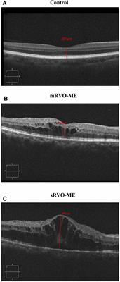 Metabolite Changes in the Aqueous Humor of Patients With Retinal Vein Occlusion Macular Edema: A Metabolomics Analysis